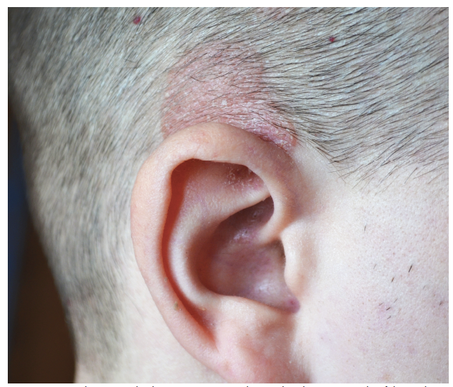 Scalp Pruritus Itching for Treatment Part I